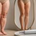 Tirzepatida pode ser aliada no controle de fatores associados ao lipedema, mas não substitui tratamento da doença 50 Tirzepatida pode ser aliada no controle de fatores associados ao lipedema, mas não substitui tratamento da doença